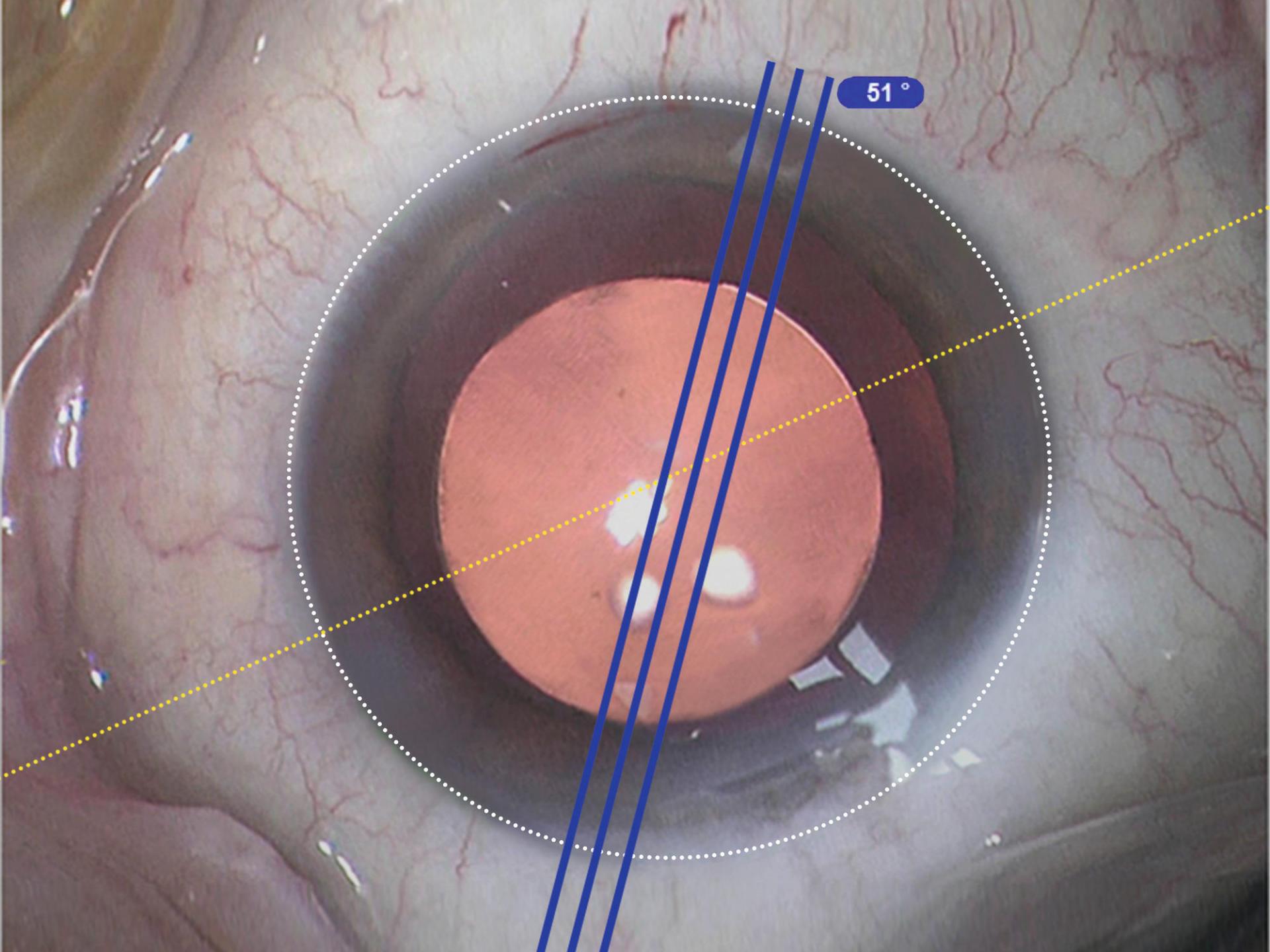 Visualização do CALLISTO eye Z ALIGN com linhas digitais que indicam o eixo para alinhamento de uma lente tórica