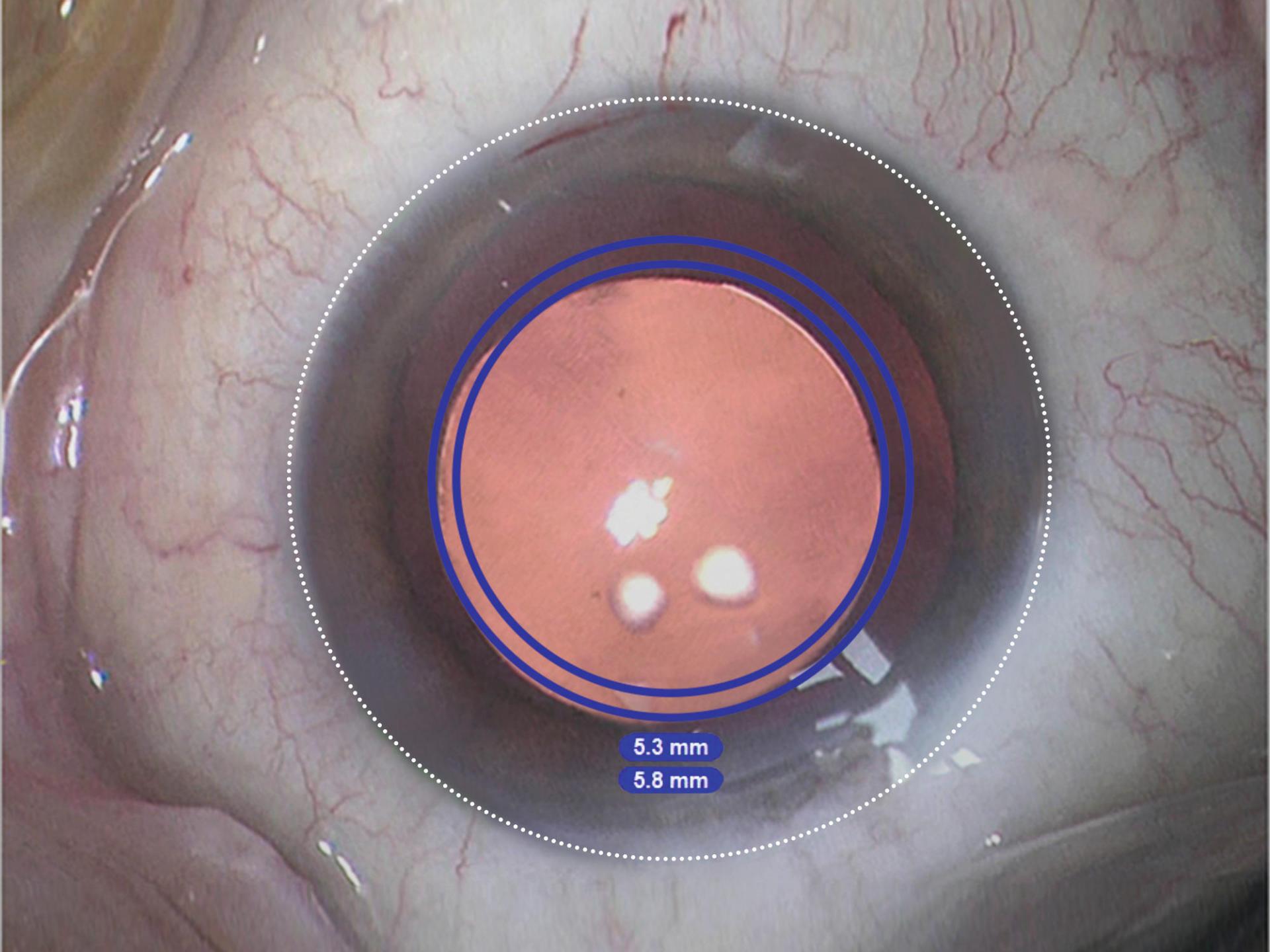 Visualização do CALLISTO eye com guias circulares sobre a imagem do olho para orientação da capsulorrexis