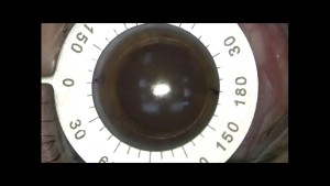 Marcação manual dos eixos na superfície do olho