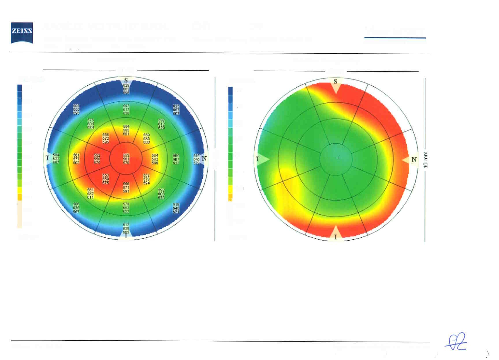 Como se deteta o Glaucoma? — ilustração