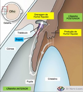 Como se distingue o Glaucoma de Ângulo Aberto do Glaucoma de Ângulo fechado? — ilustração
