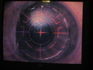 Erro refrativo após Cirurgia — ilustração