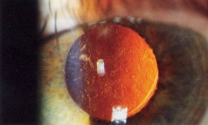 O que significa ter a lente intraocular “suja”? — ilustração