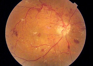 Retinopatia Diabética — ilustração