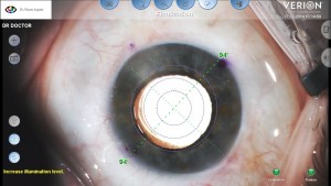 Visualização cirúrgica com referências digitais do sistema Alcon – VERION