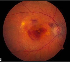 Degenerescência Macular Relacionada com a Idade — ilustração