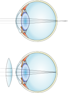 Erro Refractivo — ilustração