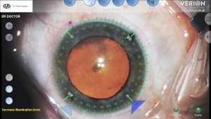 Sistema Alcon – VERION de orientação digital da cirurgia