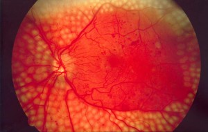 Retinopatia Diabética — ilustração