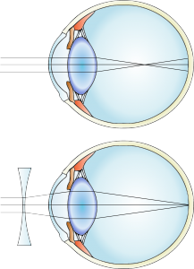 Erro Refractivo — ilustração